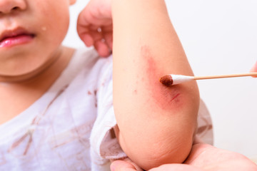 Asian boy kid show arm accident His mother washed the wound he painful abrasion scratches from fall