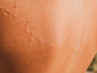 Fototapeta premium Sunburn on the skin of the back. Exfoliation, skin peels off. Dangerous sun tan