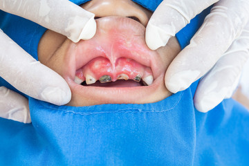 .Mouth ulcers, pain from ulcers. Burning sensation in the mouth and bad smells, stains, tooth decay...