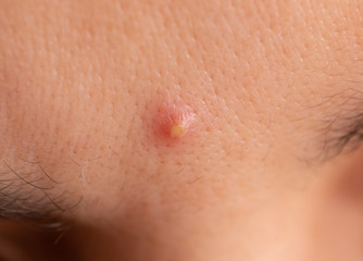 inflamed acne on the skin of the face