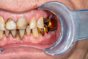Obraz premium Dental crown metal ceramics close-up in the patient's mouth in the dental clinic. The concept of prosthetics with the use implants and dentures