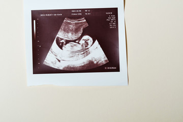 Ultrasound scan of a child.  20 weeks, 5 months