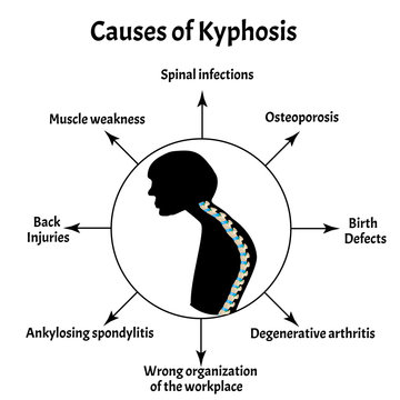 Causes of kyphosis. Spinal curvature, kyphosis, lordosis, scoliosis, arthrosis. Poor posture and slouching. Infographics. Vector illustration on isolated background.