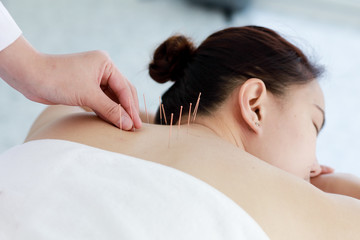 hand of doctor performing acupuncture therapy . Asian female undergoing acupuncture treatment with a line of fine needles inserted into the her body skin in clinic hospital - 313418208