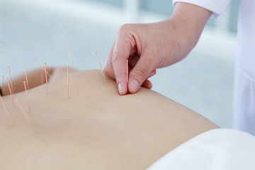 hand of doctor performing acupuncture therapy . Asian female undergoing acupuncture treatment with a line of fine needles inserted into the her body skin in clinic hospital