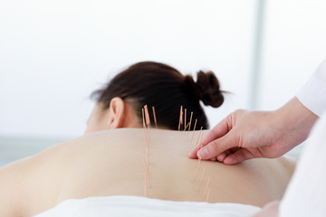 hand of doctor performing acupuncture therapy . Asian female undergoing acupuncture treatment with...
