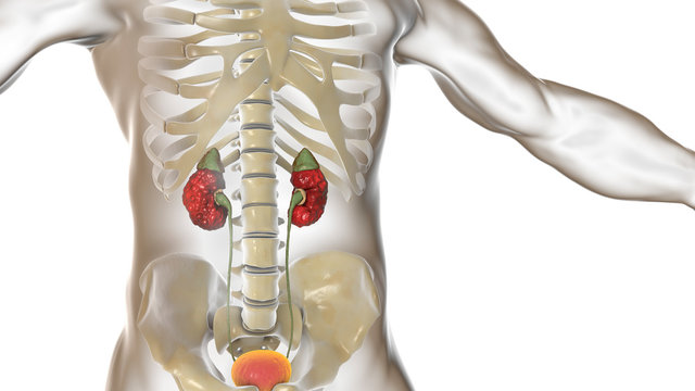 Chronic pyelonephritis, 3D illustration showing irregular scarred cortical surface particularly at poles and dilated ureter