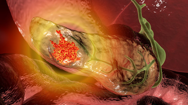 Pancreatic cancer, malignant tumor of pancreas, 3D illustration
