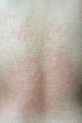 Close up Allergy rash, Around Back view of asian women with dermatitis problem of rash ,Allergy rash and Health problem.