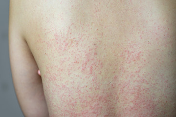 Close up Allergy rash, Around Back view of asian women with dermatitis problem of rash ,Allergy rash and Health problem.