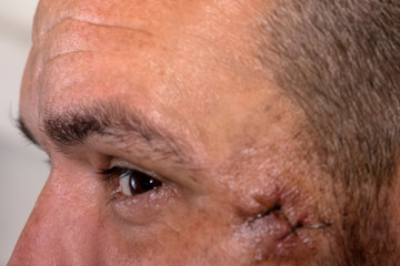 Medical sutures on the face after surgery on the temporal bone. Suture wound at the temple. Stitched skin on the face of a young man after surgery