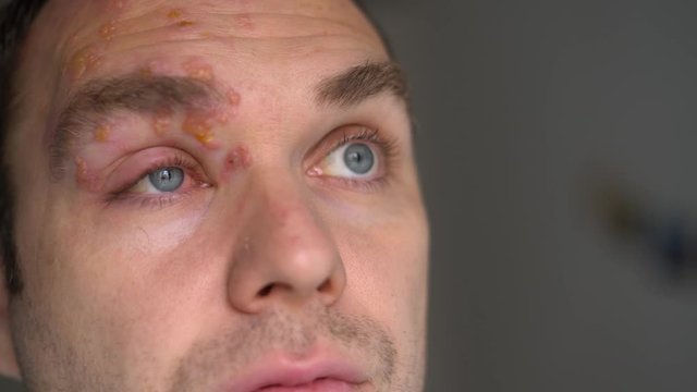 Man with Herpes Zoster, shingles, on face, close up. Inflamed eyelid and red eye