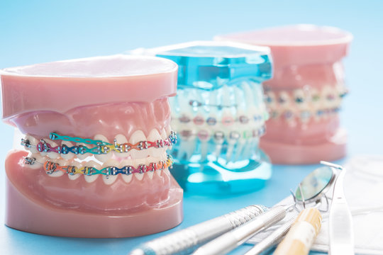 orthodontic model and dentist tool - demonstration teeth model of varities of orthodontic bracket or brace