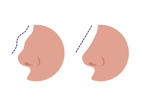 Nose Before And After Rhinoplasty Correction