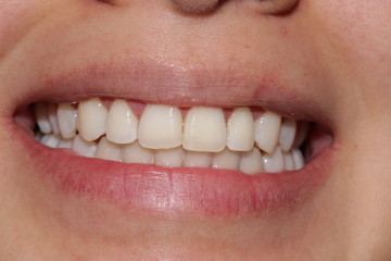 squared teeth smile