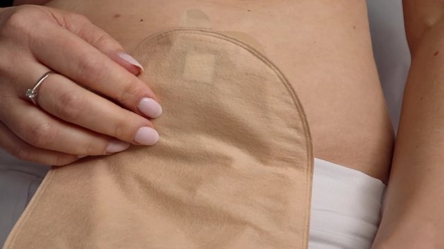 Front view on colostomy bag attached to woman patient, medical theme. Skin color ostomy pouch close-up. Colon cancer surgery treatment. 