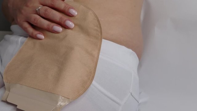 Front view on colostomy bag attached to woman patient, medical theme. Skin color ostomy pouch close-up. Colon cancer surgery treatment. 