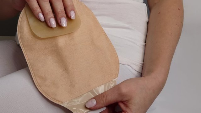 Colostomy bag, supply needed after colostomy surgery - colon cancer treatment. 2 piece ostomy bag in skin color. Medical theme. Stoma bag ready to use