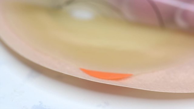 Selective focus on removing foil of adhesive part of colostomy bag. Medical theme. Stoma pouch ready to use.