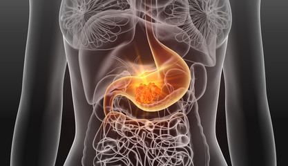 Stomach cancer. medically 3D illustration_2