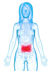 3d rendered medically accurate illustration of a diseases small intestine