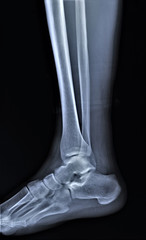 normal radiography of the ankle joint in the lateral projection