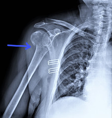radiography of the shoulder joint in direct projection with a fracture of the head of the humerus,...