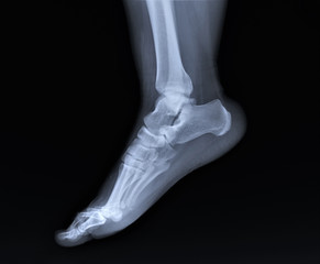 radiograph of the ankle joint  with a fracture of the outer ankle without displacement,...