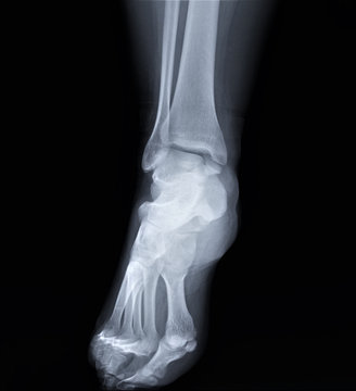 x-ray of the ankle joint in direct projection