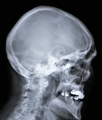 x-ray of the skull with the cervical spine