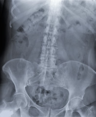 x-ray of the abdominal cavity and pelvis in direct projection, medical research,urography