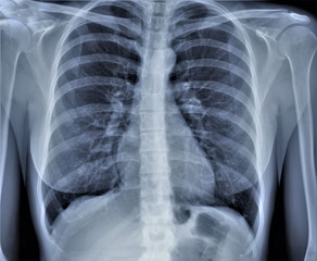 normal radiography of chest organs in direct projection, traumatology and orthopedics,  injury