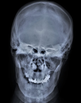 x-ray of the skull with a smile,medical diagnostics,neurosurgery