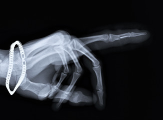 x ray with a fracture of the middle phalanx 2 fingers of the hand