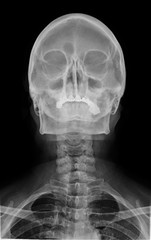x-ray of the skull with the cervical spine