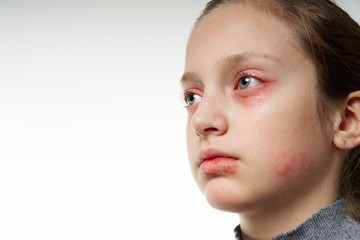 Allergic reaction, skin rash, close view portrait of a girl's face. Redness and inflammation of the skin in the eyes and lips. Immune system disease.