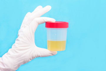 medical analysis of urine. The doctor holds in his hand a urine test in a jar with a red lid. healthcare and medicine.