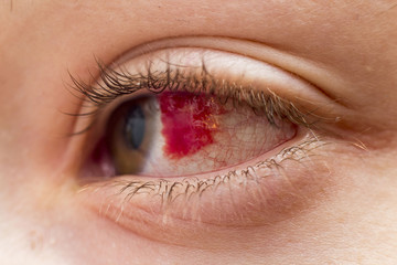 blutiges auge einer frau