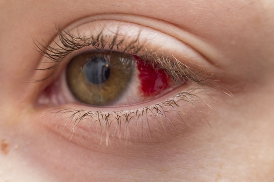 blutiges auge einer frau