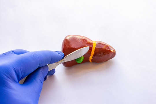 Concept of photo of cholecystectomy surgery operation or gallbladder or bile bladder of patient. Doctor holds in his hand, dressed in surgical glove, scalpel over anatomical figure gallbladder liver 