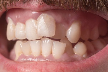 Close-up of very crooked teeth in an adult bearded guy. Not the right bite. Not healthy teeth....