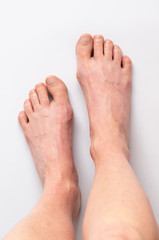 Bunions. Hallux valgus, feet isolated. Middle-aged woman's feet seen from above.