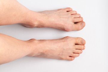 Bunions. Hallux valgus, feet isolated. Middle-aged woman's feet seen from above.