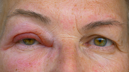 CLOSE UP: Caucasian lady with an infected and swollen eye looks into the camera.