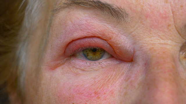CLOSE UP, DOF: Detailed shot of an ageing Caucasian woman's itchy swollen eye.