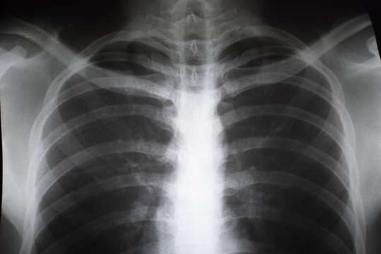 Close up of X-ray film of male teen. Concept of Healthcare