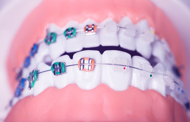 Dental brackets teeth straighteners