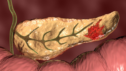 Pancreatic cancer, malignant tumor of pancreas, 3D illustration