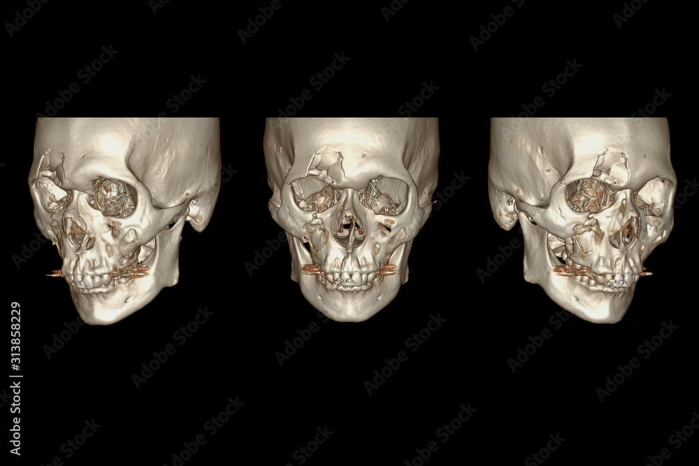 Poster ct facial bone 3d rendering image isolated on black background showing fracture frontal bone .