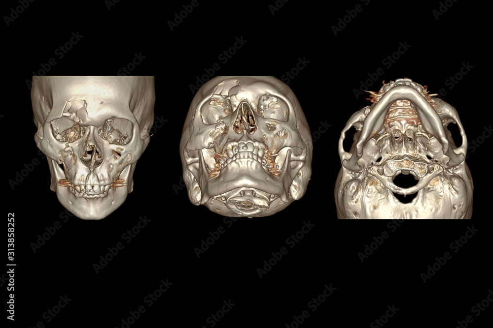 Poster ct facial bone 3d rendering image isolated on black background showing fracture frontal bone .